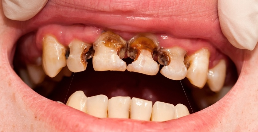 Nhiều người có hàm răng xấu mà không biết nguyên nhân bắt nguồn từ đâu