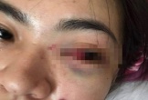 Hà Tĩnh: Nữ sinh lớp 11 bị nhóm bạn đánh tụ máu mắt