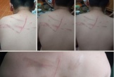 Làm bài tập chậm, học sinh bị đánh bầm tím lưng