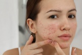 Nguyên nhân khiến da mụn mãi không khỏi