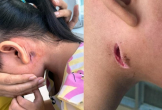 Nhiều người nhiễm vi khuẩn 