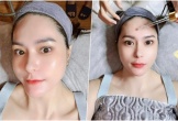 Nữ đại gia quận 7 chi nửa tỷ cấy filler mặt, ngoài đời không 