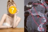 Sốc: Sao nữ nghiện “dao kéo” tung ảnh chụp X-quang khuôn mặt với dị vật 3cm tồn tại trong cằm suốt 8 năm