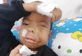 Mong manh sự sống của bé trai 8 tuổi có khuôn mặt biến dạng vì bệnh hiểm nghèo