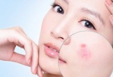 Giữ da khỏe mạnh, nói không với mụn