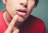 Dấu hiệu cảnh báo bệnh gan biểu hiện ngay trên mặt