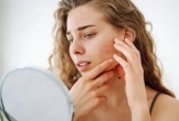 Chăm sóc da mụn hiệu quả trong thời tiết hanh khô của mùa Thu