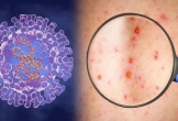 Xuất hiện ca bệnh đậu mùa khỉ chưa rõ nguồn lây ở Đồng Nai