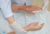 Bồn cầu phát nổ sau khi đổ hóa chất, người phụ nữ bỏng nặng