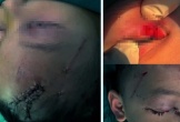 Nghệ An: Cấp cứu trẻ bị chó cắn tổn thương nghiêm trọng vùng mặt