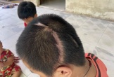 Vụ học sinh lớp 3 bị xe tông tổn thương 90%: Tòa án mời các bên liên quan làm việc lần hai