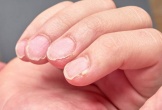 5 dấu hiệu trên móng tay cảnh báo bạn đang thiếu vitamin nghiêm trọng