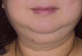 Dùng corticoid kéo dài, nguy cơ gây ra bệnh cushing