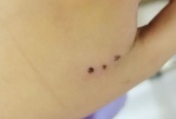 Bé 10 tuổi nhập viện sau khi bị chuột cắn
