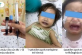 Dùng nước giếng nấu ăn, máu của bé gái chuyển nâu