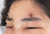 Nặn mụn trứng cá, nữ bệnh nhân nhập viện nguy kịch