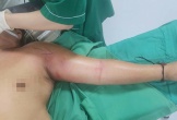 Nhiễm trùng nặng vì tự tiêm mật gấu vào tay để chữa đau ngực