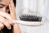 Không chỉ tuổi tác, đây còn là “thủ phạm” dẫn đến rụng tóc