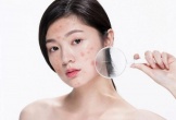 5 loại trái cây là 'khắc tinh' của mụn trứng cá, ăn càng nhiều da càng thêm đẹp