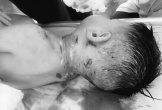Bé trai 3 tuổi bị chó nhà hàng xóm cắn lộ xương sọ