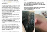 Nguy hiểm từ mẹo chữa đột quỵ bằng kim chích đầu ngón tay lan truyền trên mạng