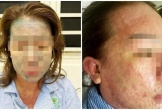 Nữ bệnh nhân nguy kịch sau khi dùng “thuốc giảm cân thải độc, collagen không rõ nguồn gốc”