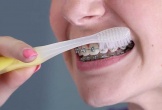 Cách chăm sóc răng miệng khi niềng răng