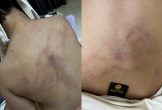 Phụ huynh tố con bị giáo viên 'đánh đập thô bạo, ném vào tường'