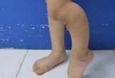 Bé gái 5 tuổi gãy xương đã được bó bột, bố mẹ vẫn khoét lỗ trên bột để đắp lá khiến xương không thể liền