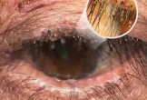 Ngứa mắt khó chịu, người bệnh sốc khi bác sĩ tìm thấy “thủ phạm” ở bờ mi