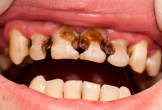 Nhiều người có hàm răng xấu mà không biết nguyên nhân bắt nguồn từ đâu