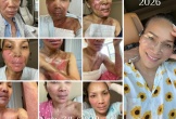 Xót xa nữ nghệ sĩ đình đám bị bỏng nghiêm trọng vì nổ nồi xông hơi: 