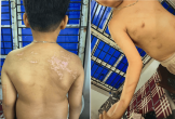 Bé trai 7 tuổi có 21 vết sẹo trên cơ thể do bị cha đẻ bạo hành