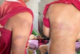 Công an làm việc với ông bố dùng roi tre đánh con bầm tím 