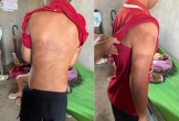 Diễn biến mới vụ cháu bé xuất hiện nhiều vết bầm tím trên cơ thể