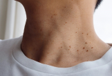 Dấu hiệu ngầm cảnh báo kháng insulin nhiều người dễ bỏ qua