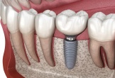 Mách bạn địa chỉ trồng răng chất lượng cao tại Nghệ An