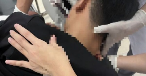 Nghệ An: Xô xát khi múa lân, thiếu niên bị n.ém vật nhọn vào mặt gây trọng thương