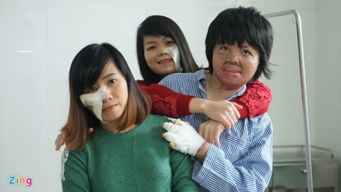 Chị Dung chụp ảnh với bạn cùng phòng bệnh tại Viện Bỏng Quốc gia Lê Hữu Trác trước khi về quê ăn Tết. Đầu tháng 3, chị sẽ quay lại viện bỏng để thực hiện ca phẫu thuật vi phẫu tái tạo khuôn mặt. 